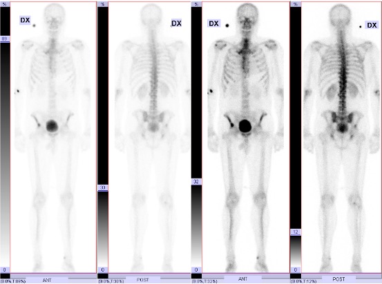 Metastas-i-backanet.jpg